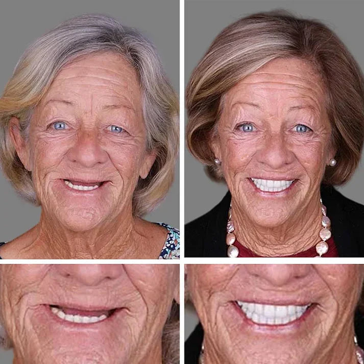 Ends Today: 70% OFF! ⏰70% OFF! KLENIMORE™ Medical Full Denture with Strong Suctiond Custom-Fit Full Functional Dentures🦷Obtain American Dental Association (ADA) Certification