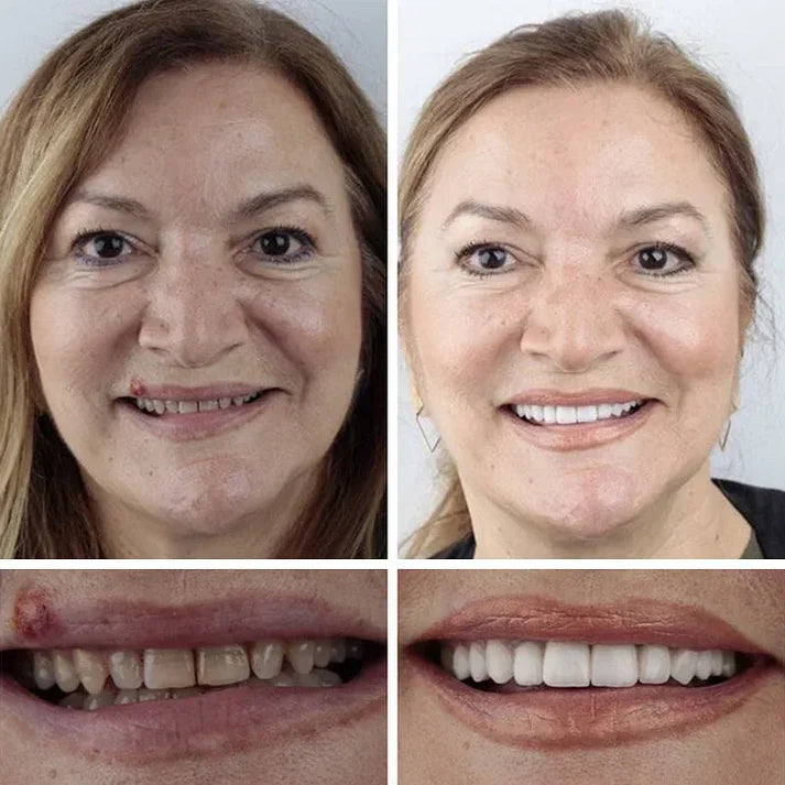 Ends Today: 70% OFF! ⏰70% OFF! KLENIMORE™ Medical Full Denture with Strong Suctiond Custom-Fit Full Functional Dentures🦷Obtain American Dental Association (ADA) Certification