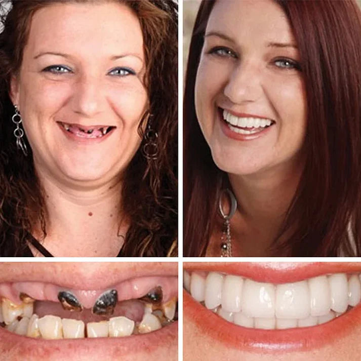 Ends Today: 70% OFF! ⏰70% OFF! KLENIMORE™ Medical Full Denture with Strong Suctiond Custom-Fit Full Functional Dentures🦷Obtain American Dental Association (ADA) Certification