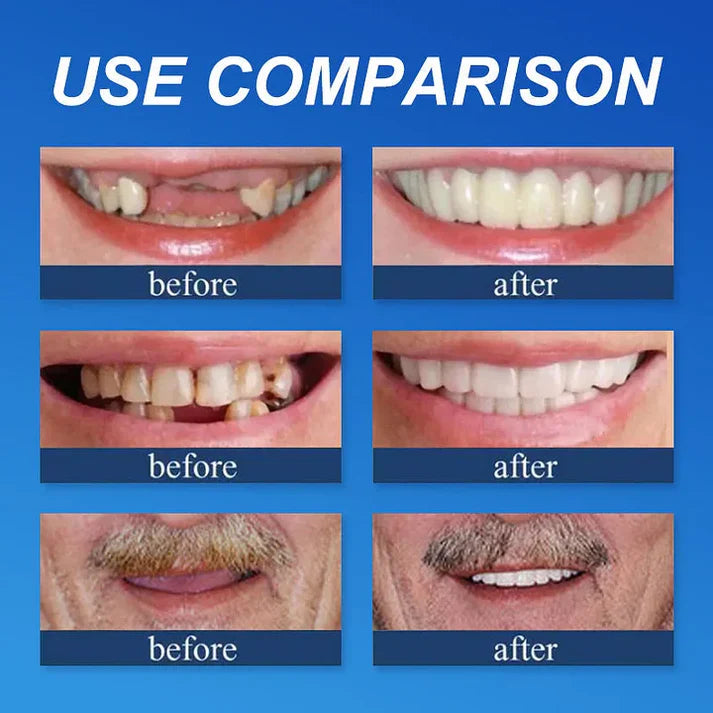 Ends Today: 70% OFF! ⏰70% OFF! KLENIMORE™ Medical Full Denture with Strong Suctiond Custom-Fit Full Functional Dentures🦷Obtain American Dental Association (ADA) Certification